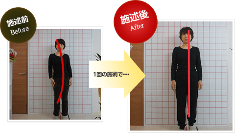 大阪府堺市_テアシス堺鳳整体院_ヘルニア姿勢変化