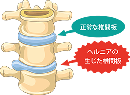大阪府堺市_テアシス堺鳳整体院_ヘルニア