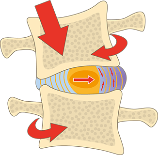 大阪府堺市_テアシス堺鳳整体院_ヘルニア