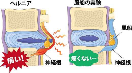 大阪府堺市_テアシス堺鳳整体院_ヘルニア