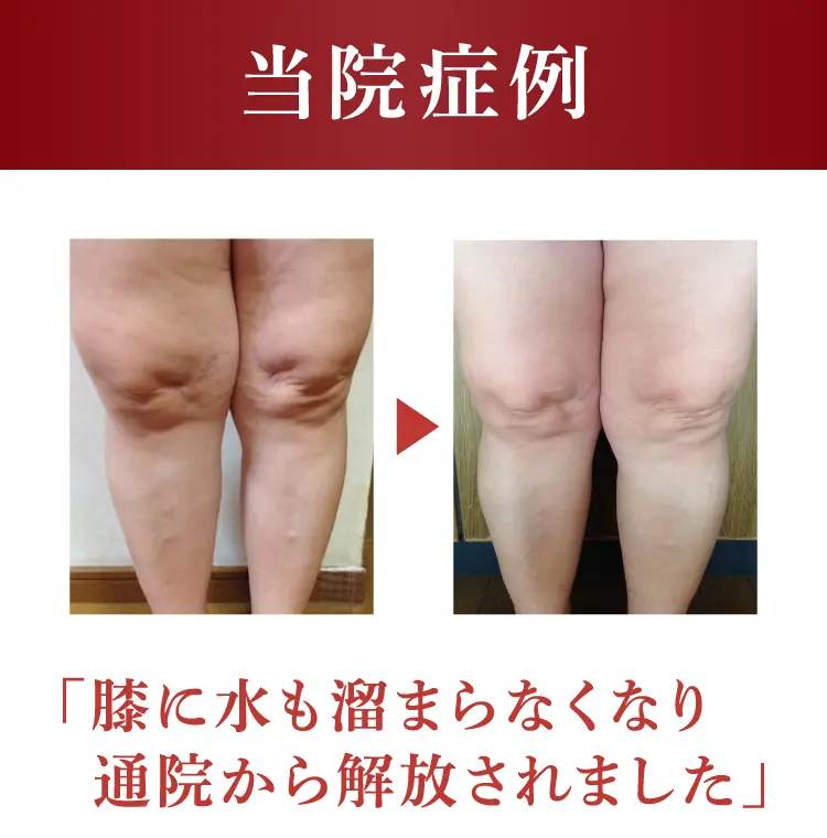 大阪府堺市_テアシス堺鳳整体院_膝症例